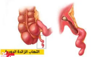 التهاب الزائدة الدودية: أعراض خطيرة تظهر على جسمك قبل انفجارها بساعات